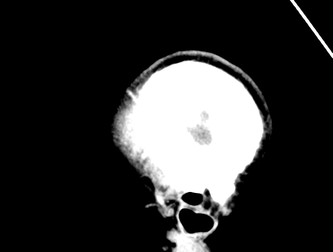 Cerebral abscess (Radiopaedia 60342-68008 Sagittal C+ delayed 4).png