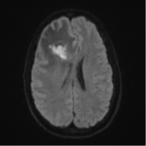 Cerebral abscess (Radiopaedia 60342-68009 Axial DWI 59).png