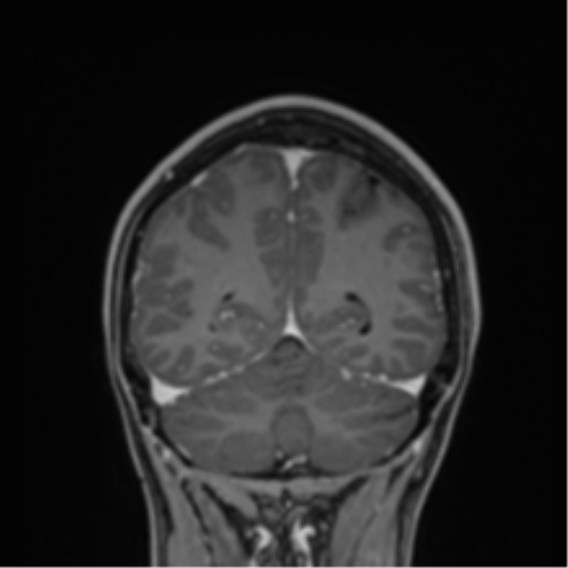 File:Cerebral abscess (Radiopaedia 60342-68009 H 9).png
