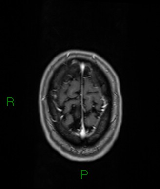 Cerebral abscess and subdural empyema (Radiopaedia 84436-99779 Axial T1 C+ 13).jpg