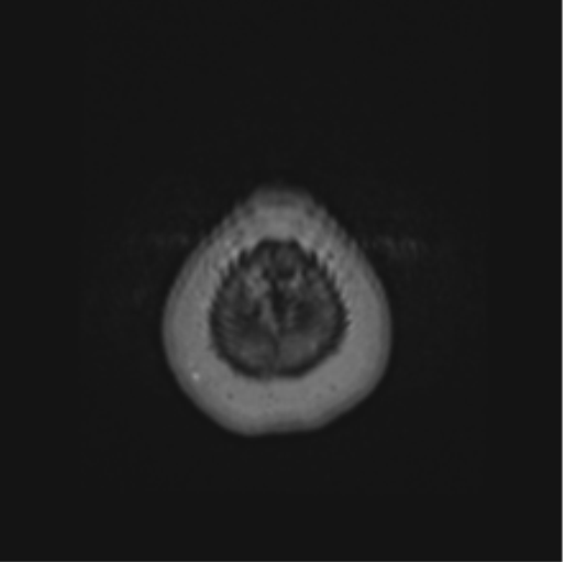 Cerebral abscess from pulmonary arteriovenous malformation (Radiopaedia 86275-102291 J 73).png