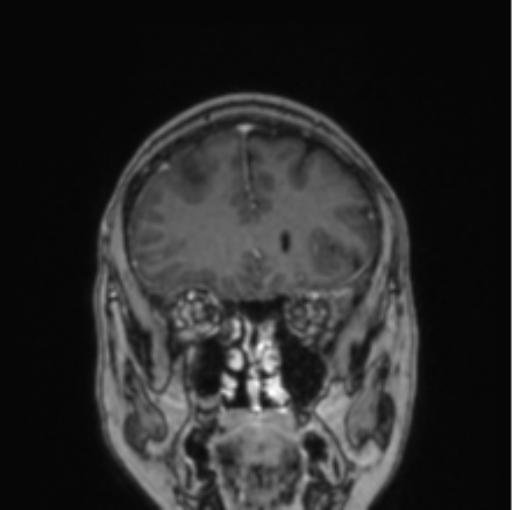 File:Cerebral abscess from pulmonary arteriovenous malformation (Radiopaedia 86275-102291 L 66).png