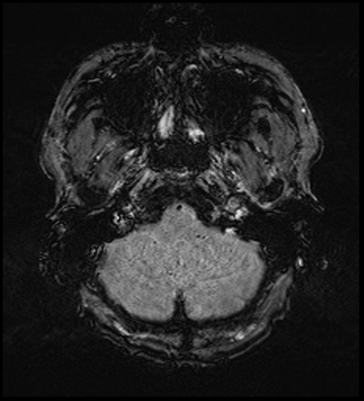 Cerebral abscess with ventriculitis (Radiopaedia 78965-91878 Axial SWI 10).jpg