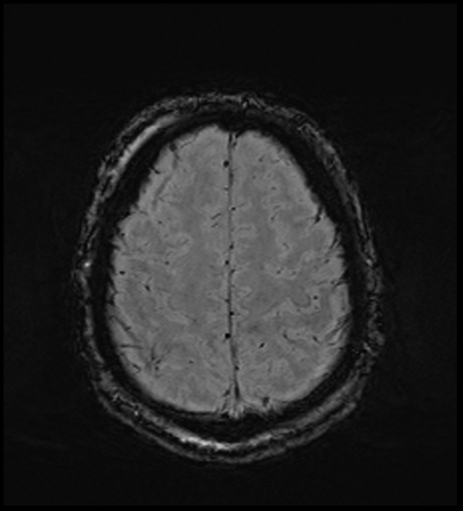 Cerebral abscess with ventriculitis (Radiopaedia 78965-91878 Axial SWI 43).jpg
