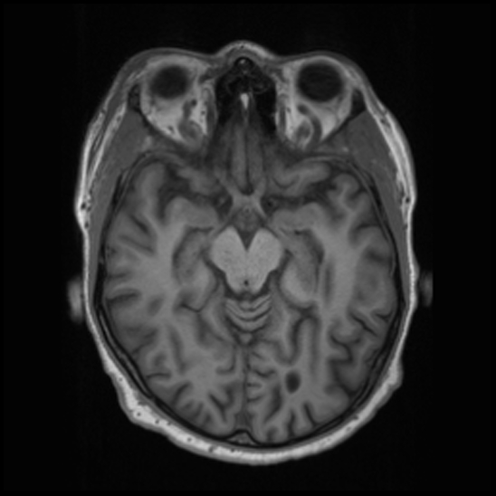 File:Cerebral abscess with ventriculitis (Radiopaedia 78965-91878 Axial T1 20).jpg