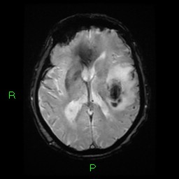 File:Cerebral amyloid angiopathy-associated lobar intracerebral hemorrhage (Radiopaedia 58376-65512 Axial Gradient Echo 13).jpg