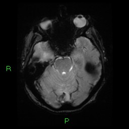 File:Cerebral amyloid angiopathy-associated lobar intracerebral hemorrhage (Radiopaedia 58376-65512 Axial Gradient Echo 18).jpg