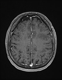 Cerebral amyloid angiopathy-related inflammation (Radiopaedia 58270-65377 Axial T1 C+ fat sat 103).jpg