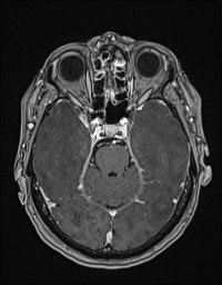 Cerebral amyloid angiopathy-related inflammation (Radiopaedia 58270-65377 Axial T1 C+ fat sat 45).jpg