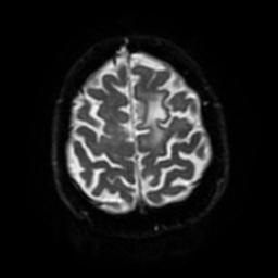 Cerebral amyloid angiopathy (Radiopaedia 28698-28978 Axial DWI 53).jpg
