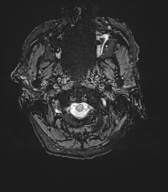File:Cerebral amyloid angiopathy (Radiopaedia 46082-50433 Axial SWI 1).png