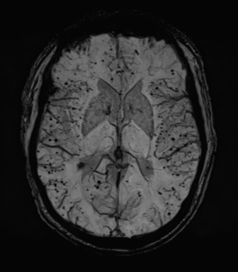Cerebral amyloid angiopathy (Radiopaedia 46082-50433 Axial SWI MIP 40).png