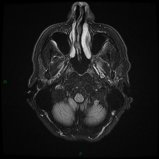 File:Cerebral amyloid angiopathy (Radiopaedia 77506-89664 Axial FLAIR 4).jpg