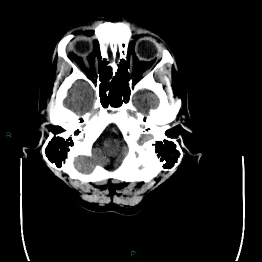 File:Cerebral amyloid angiopathy (Radiopaedia 77506-89665 Axial non-contrast 16).jpg