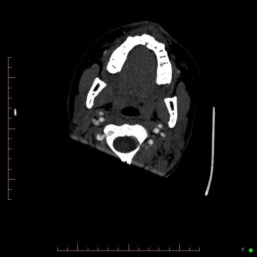 Cerebral arteriovenous malformation (AVM) (Radiopaedia 78162-90706 Axial CTA 13).jpg