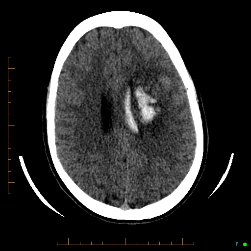 Cerebral arteriovenous malformation (AVM) (Radiopaedia 78162-90706 Axial non-contrast 43).jpg
