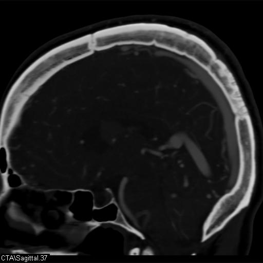 Cerebral arteriovenous malformation (Radiopaedia 28518-28759 D 34).jpg