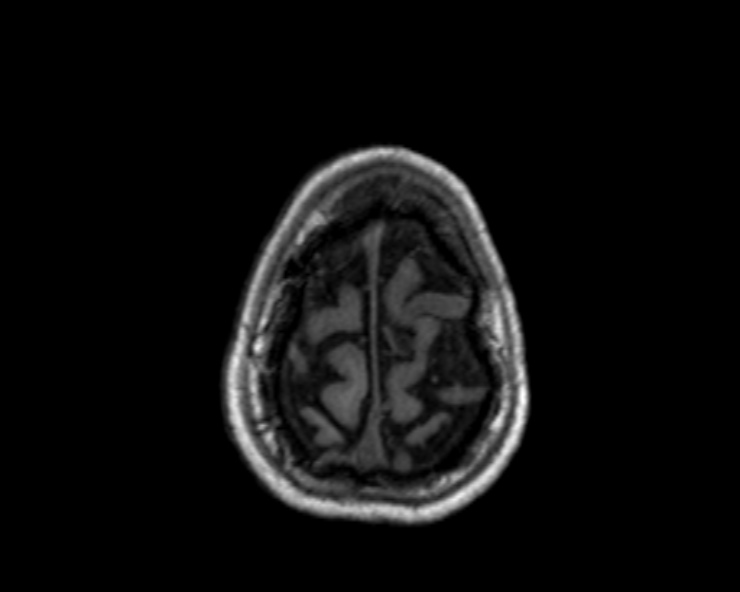 Cerebral arteriovenous malformation (Radiopaedia 30198-30813 Axial T1 15).jpg