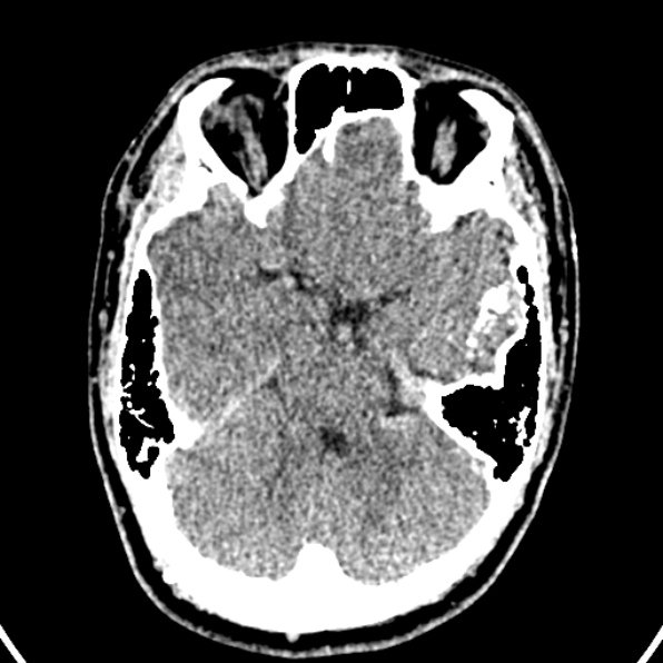 Cerebral arteriovenous malformation (Radiopaedia 37182-39012 Axial non-contrast 15).jpg