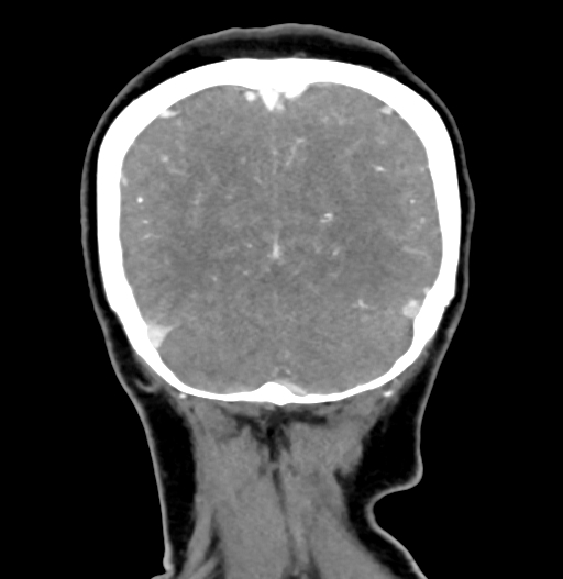 Cerebral arteriovenous malformation (Radiopaedia 73830-84645 C 81).jpg