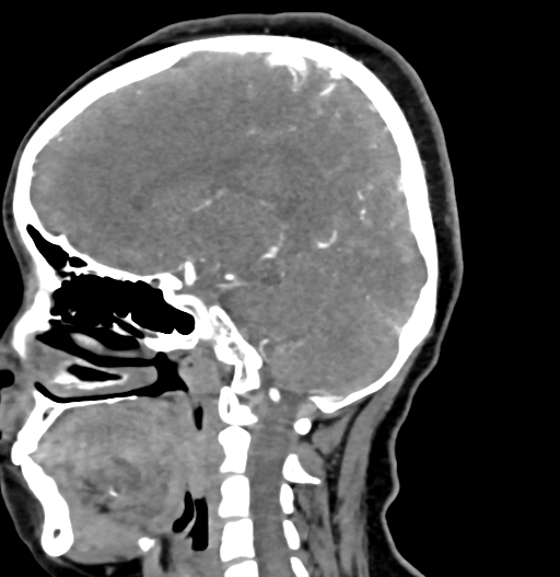 Cerebral arteriovenous malformation (Radiopaedia 73830-84645 D 54).jpg