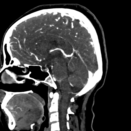 Cerebral arteriovenous malformation (Radiopaedia 73830-84645 Sagittal C+ delayed 46).jpg