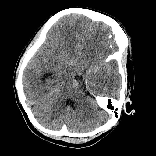 Cerebral arteriovenous malformation (Radiopaedia 79677-92887 Axial non-contrast 10).jpg