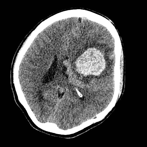 Cerebral arteriovenous malformation (Radiopaedia 79677-92887 Axial non-contrast 22).jpg