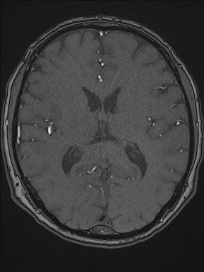 Cerebral arteriovenous malformation (Radiopaedia 84015-99245 Axial TOF 138).jpg