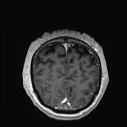 Cerebral arteriovenous malformation (Radiopaedia 84015-99245 Coronal T1 C+ 144).jpg