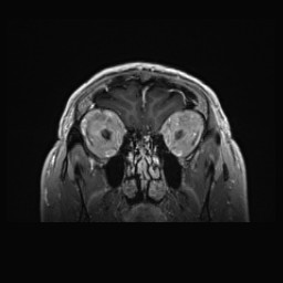 Cerebral arteriovenous malformation (Radiopaedia 84015-99245 Coronal T1 C+ 29).jpg