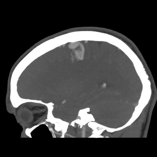 Cerebral arteriovenous malformation (Spetzler-Martin grade 2) (Radiopaedia 41262-44076 G 19).png