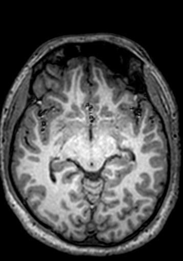 File:Cerebral arteriovenous malformation at posterior body of corpus callosum (Radiopaedia 74111-84925 Axial T1 173).jpg