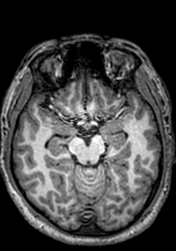 File:Cerebral arteriovenous malformation at posterior body of corpus callosum (Radiopaedia 74111-84925 Axial T1 189).jpg