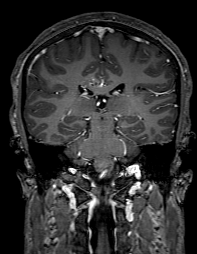 Cerebral arteriovenous malformation at posterior body of corpus callosum (Radiopaedia 74111-84925 K 222).jpg
