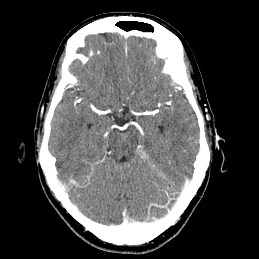 Cerebral arteriovenous malformation with lobar hemorrhage (Radiopaedia 35598-57216 A 22).jpg