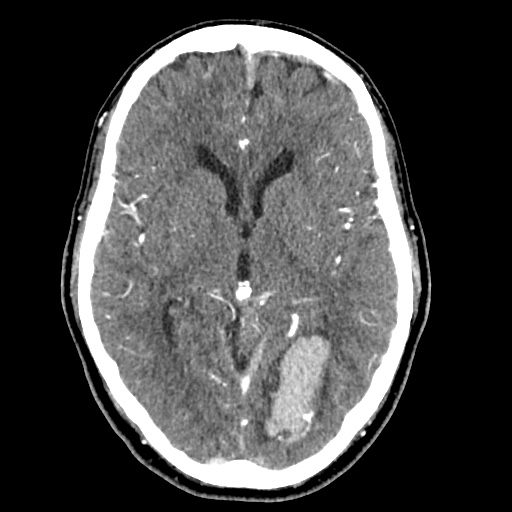 File:Cerebral arteriovenous malformation with lobar hemorrhage (Radiopaedia 35598-57216 A 29).jpg