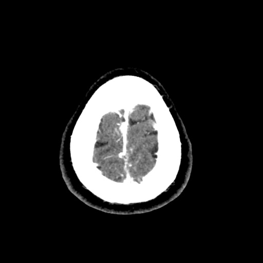 File:Cerebral arteriovenous malformation with lobar hemorrhage (Radiopaedia 35598-57216 A 58).jpg