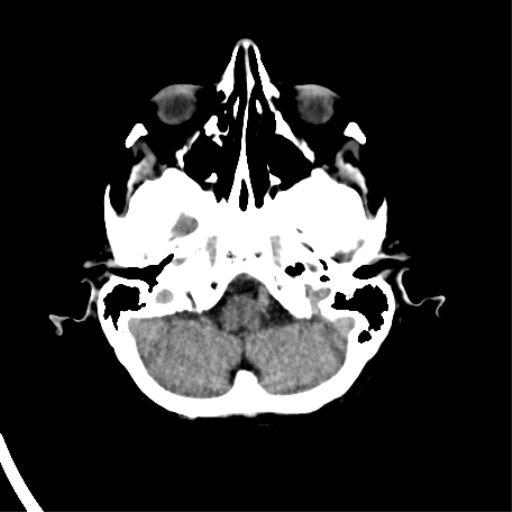 File:Cerebral arteriovenous malformation with lobar hemorrhage (Radiopaedia 44725-48510 Axial non-contrast 11).png