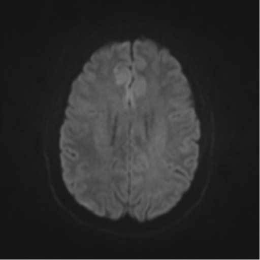 File:Cerebral cavernoma and development venous anomaly (Radiopaedia 37603-39482 Axial DWI 38).png