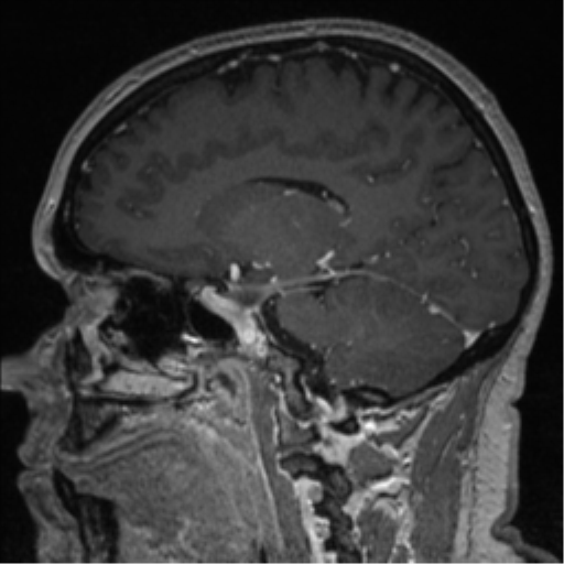 Cerebral cavernoma and development venous anomaly (Radiopaedia 37603-39482 Sagittal T1 C+ 56).png