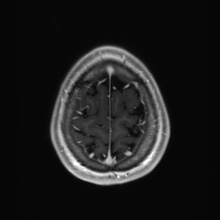Cerebral cavernous venous malformation (Radiopaedia 70008-80021 Axial T1 C+ 92).jpg