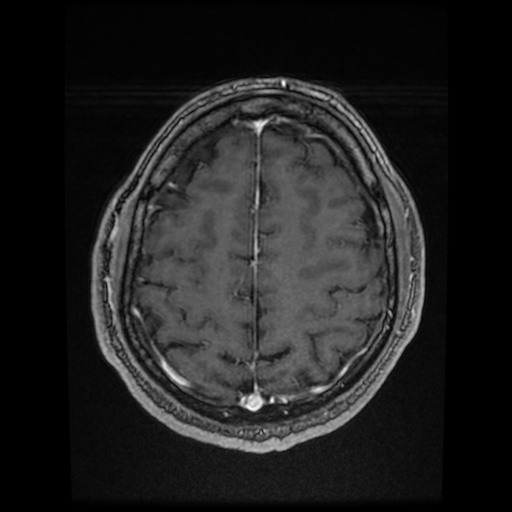 Cerebral cavernous venous malformation (Zabramski type II) (Radiopaedia 85511-101198 Axial T1 C+ fat sat 24).jpg