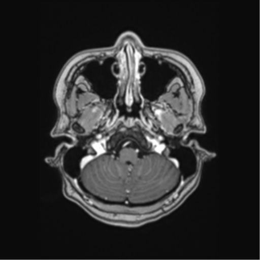 Cerebral cavernous venous malformations (Radiopaedia 48117-52946 Axial T1 C+ 4).png