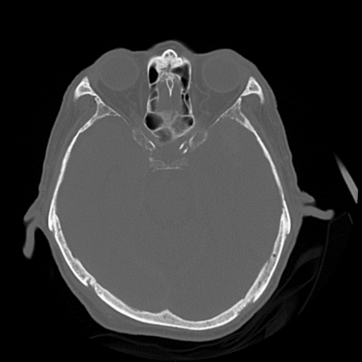 Cerebral contusions, subarachnoid hemorrhage and subdural hygromas (Radiopaedia 55399-61827 Axial bone window 20).png