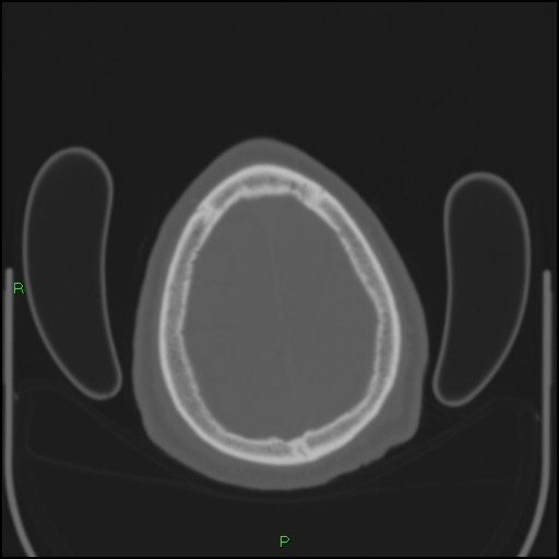 Cerebral contusions (Radiopaedia 33868-35039 Axial bone window 195).jpg