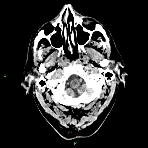 Cerebral contusions (Radiopaedia 33868-35039 Axial non-contrast 16).jpg