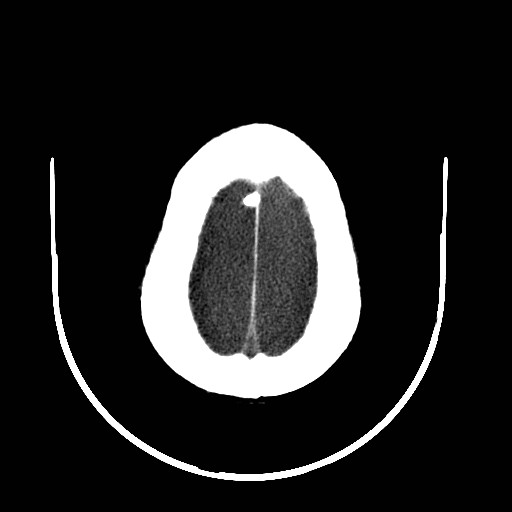 Cerebral edema (evolution in time) (Radiopaedia 19418-19439 non-contrast 82).jpg