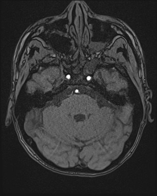 Cerebral embolic infarcts (embolic shower) (Radiopaedia 72391-82921 Axial MRA 33).jpg