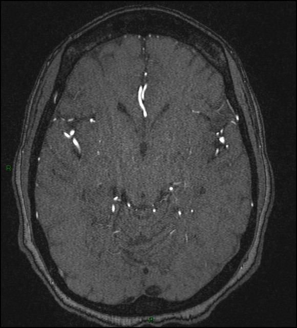 Cerebral fat embolism (Radiopaedia 35022-36525 Axial TOF 90).jpg